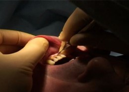 Dental Bridge